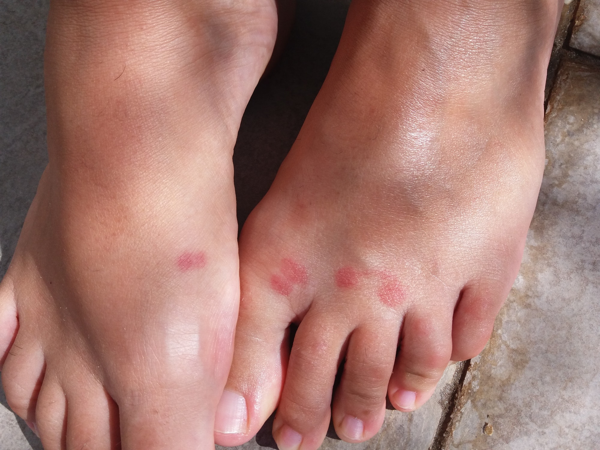 Mosquito bite on sale on foot